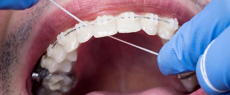 Flossing with braces